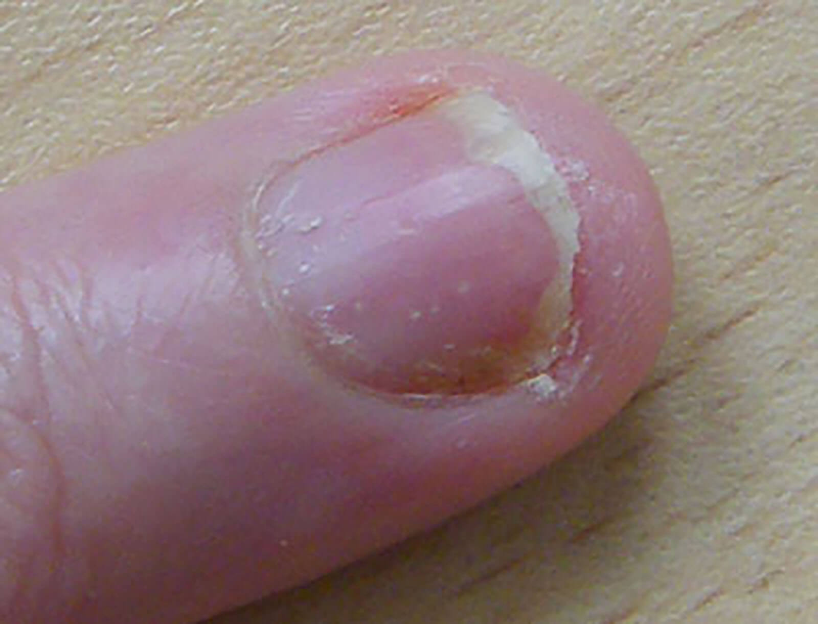 Photo Of Fingernail Psoriasis Pitting Discoloration