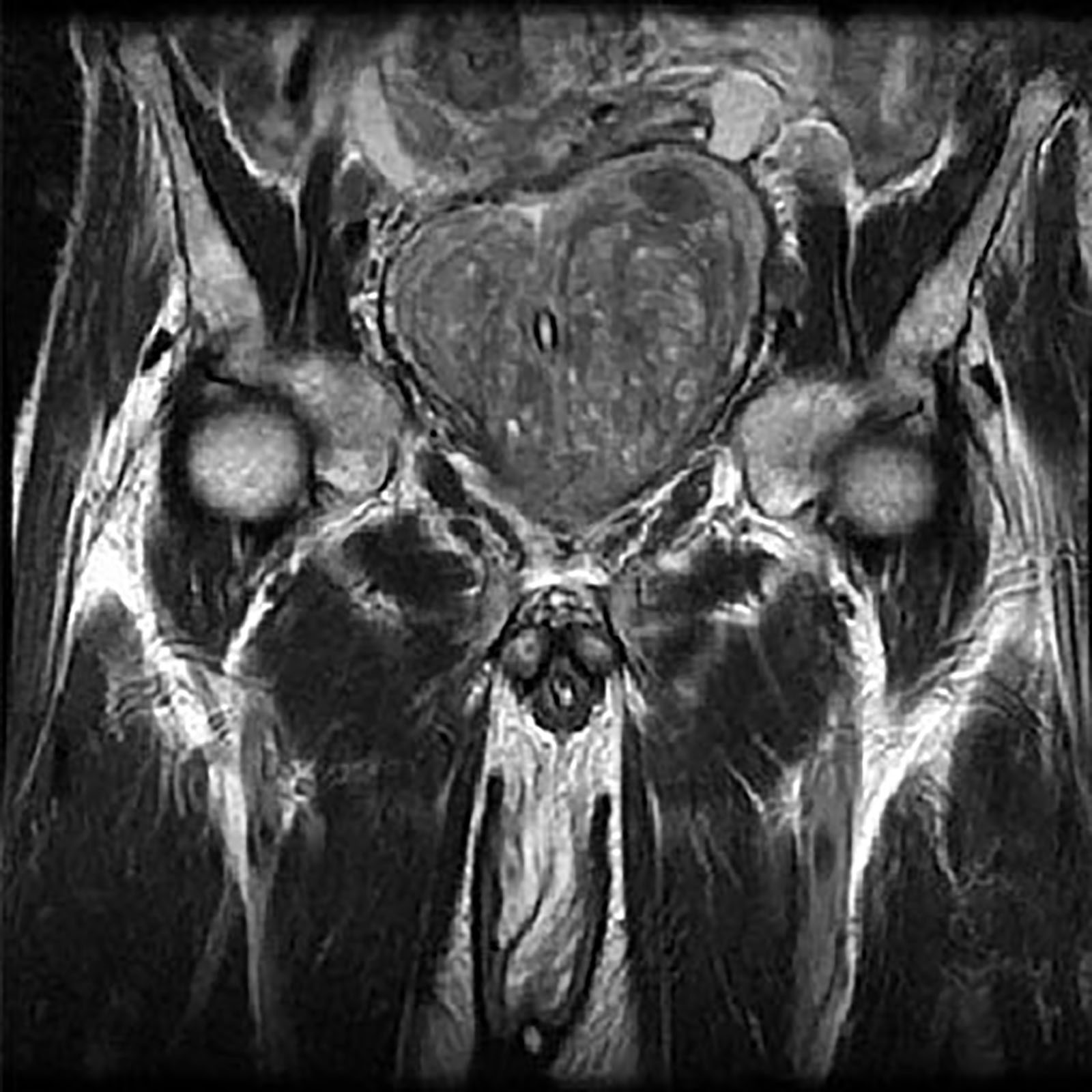 mri-scan-of-benign-prostatic-hyperplasia-bph