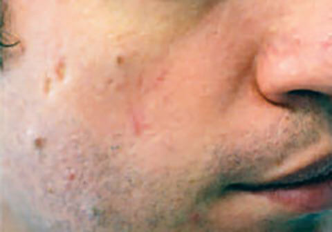 Post rosacea treatment